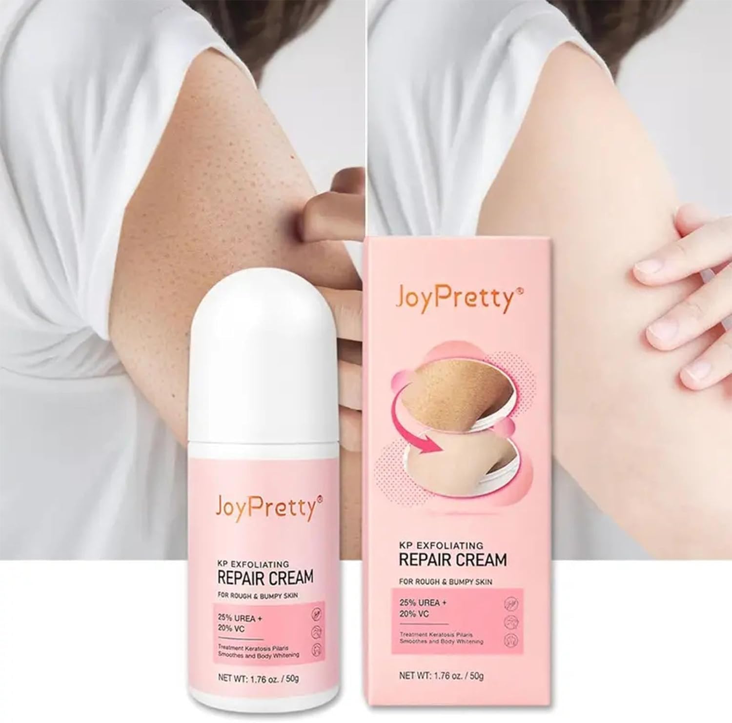 Keratosis Pilaris Lotion, Legs Treatment Body Cream Skin Exfoliating Repair Cream Chicken Skin Care Cream,Exfoliating Body Cream Rough Bumpy Skin Body Lotion Moisturizing Cream Gets Rid Of Redness