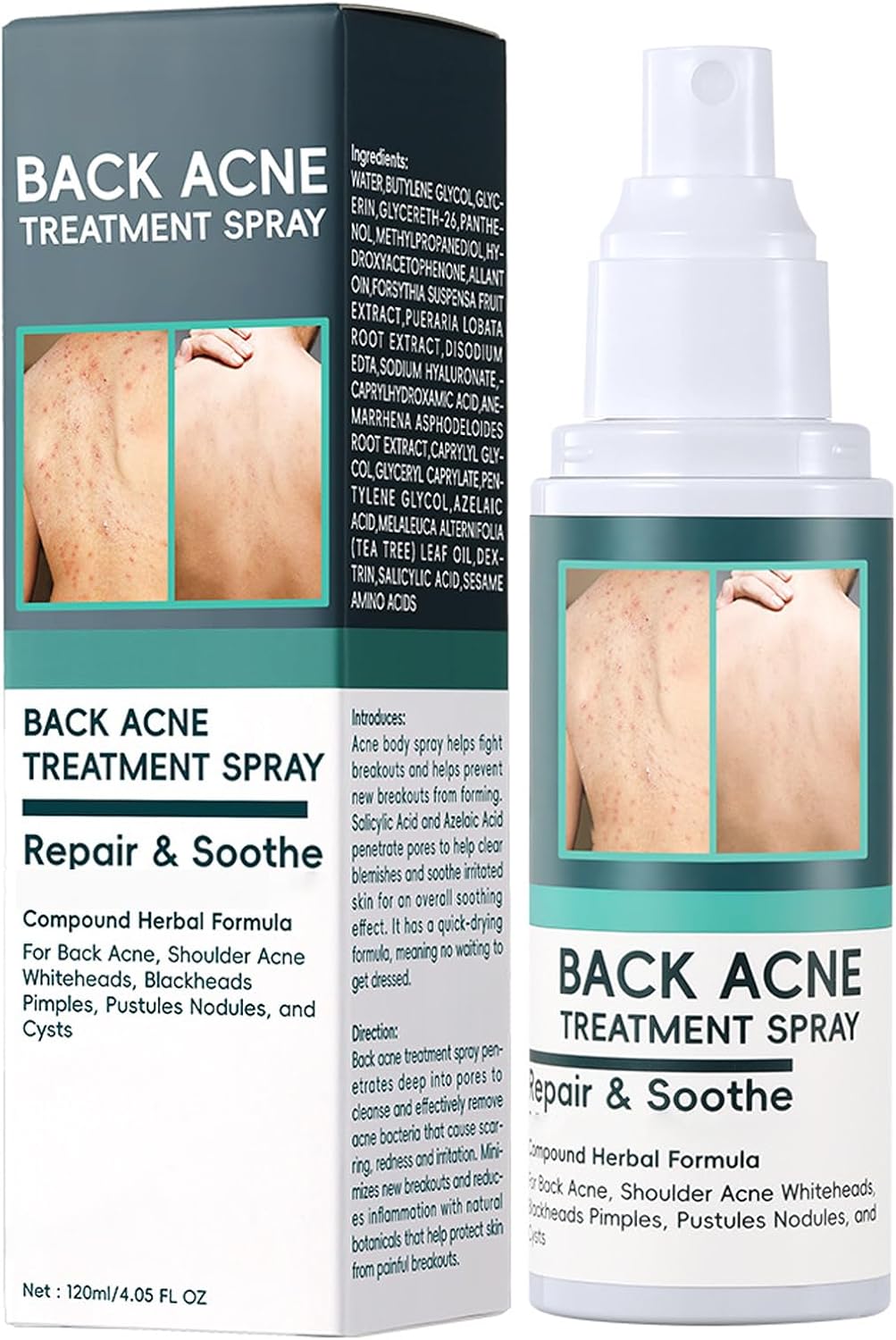 Back & Body Acne Spray,Back Acne Treatment Spray for Women,Soothing Acne Reducer Body Serum,Hydrate & Soothing,Suitable for All Skin Type,Sensitive & Oil-120ml